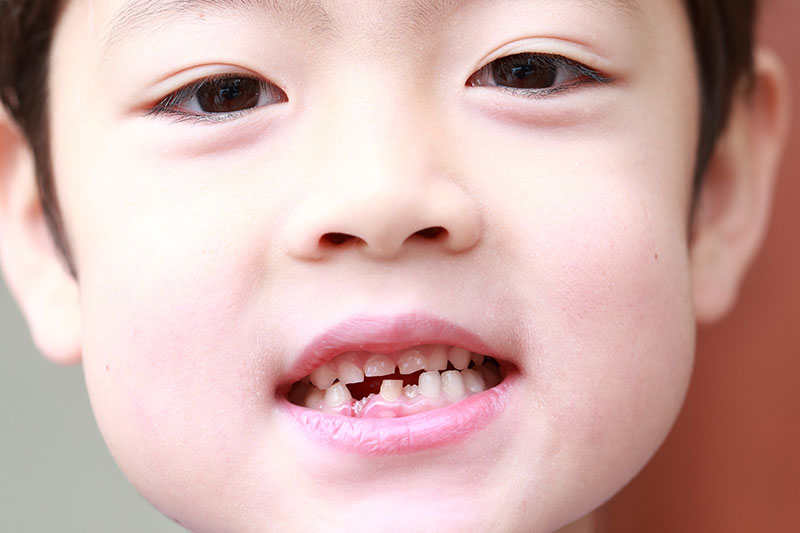 お子さまの歯は、このような状態になっていませんか？